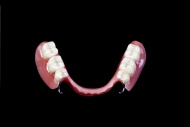 Partial dentures